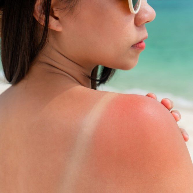 อยู่กลางแจ้งจนหน้าไหม้แดด ฟื้นฟูผิวอย่างไรดี ?